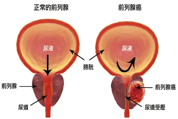 前列腺增生