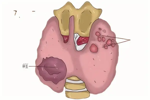 甲状腺结节