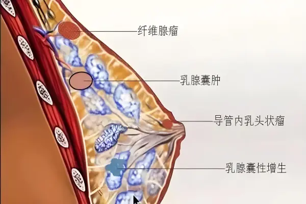 乳腺结节